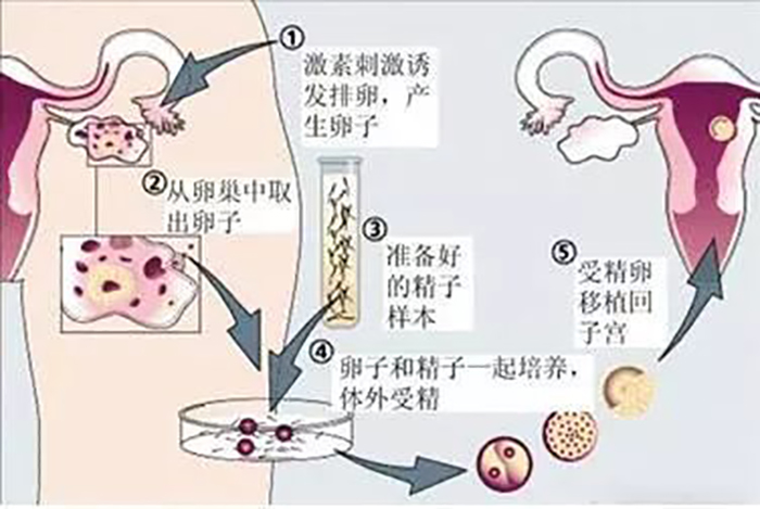 什么是自然周期做借卵试管婴儿？