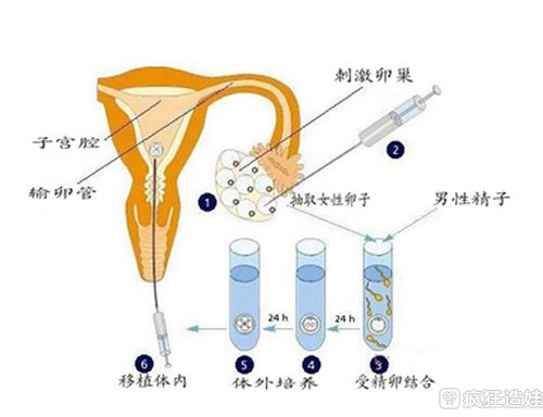 揭秘哪些地方有试管代怀的取卵全过程!看完你还敢做吗